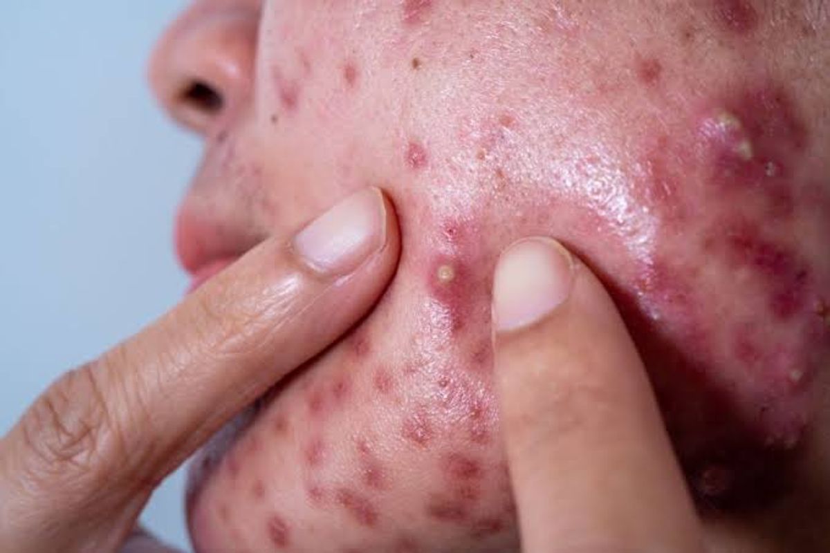 Hình ảnh mụn bọc có nhân đầu trắng 