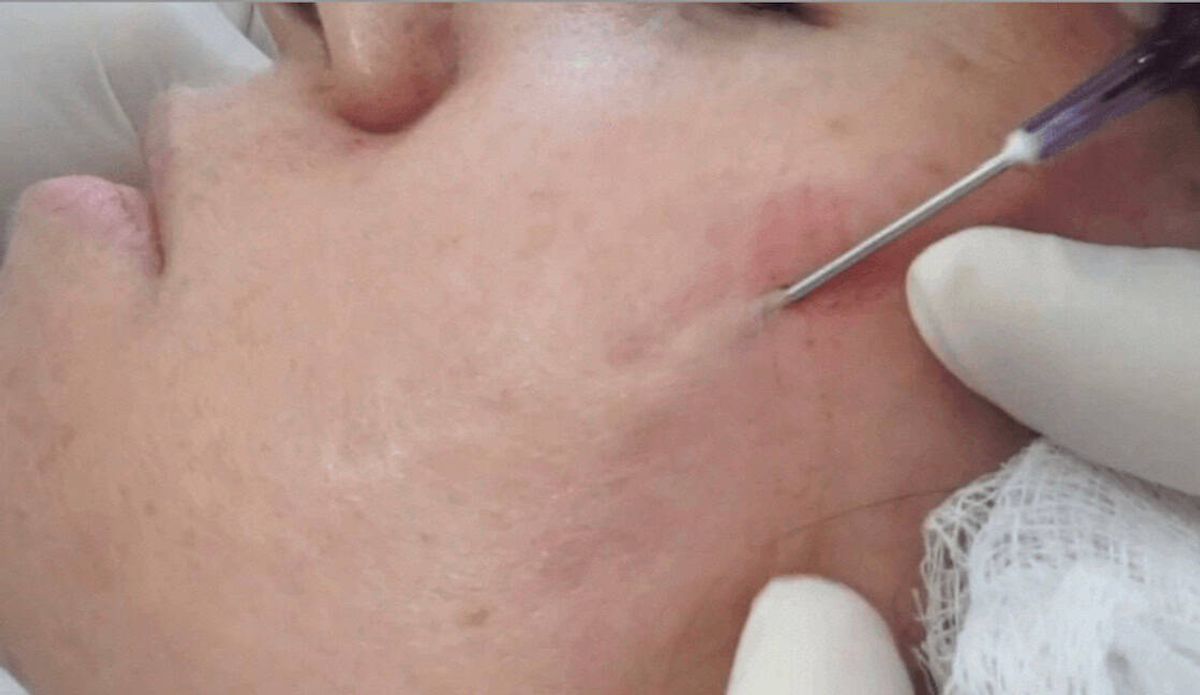 Phương pháp Subcision bóc tách 