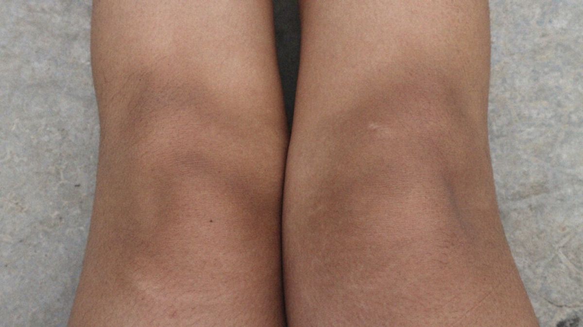 Thâm đầu gối khiến nhiều người bị mất tự tin 