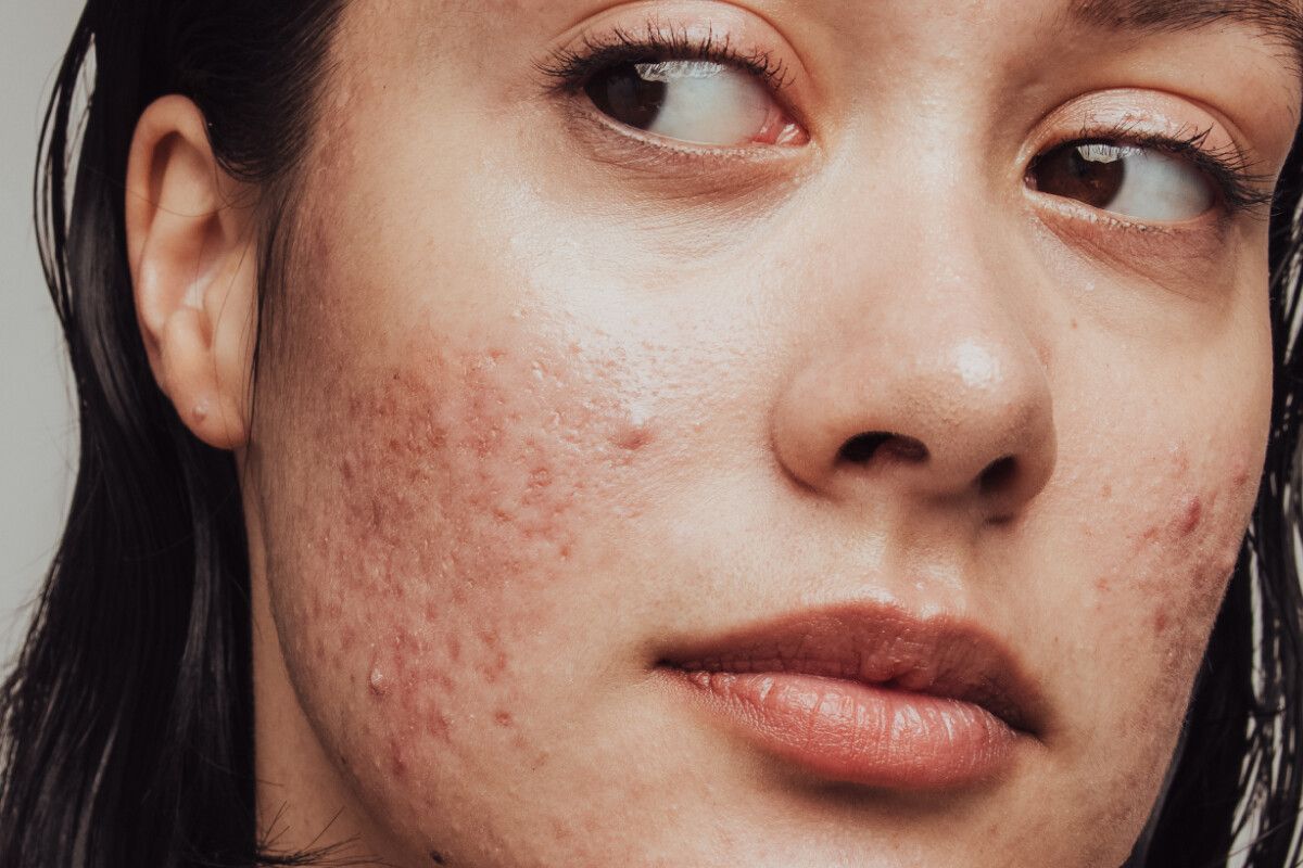 Tình trạng mụn nặng phải làm sao để khỏi 
