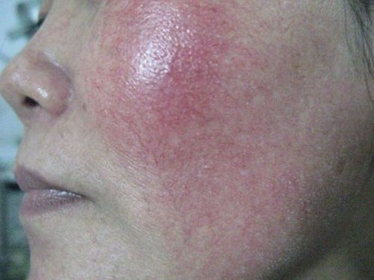 Da bị giãn mạch do dùng thuốc trị nám 
