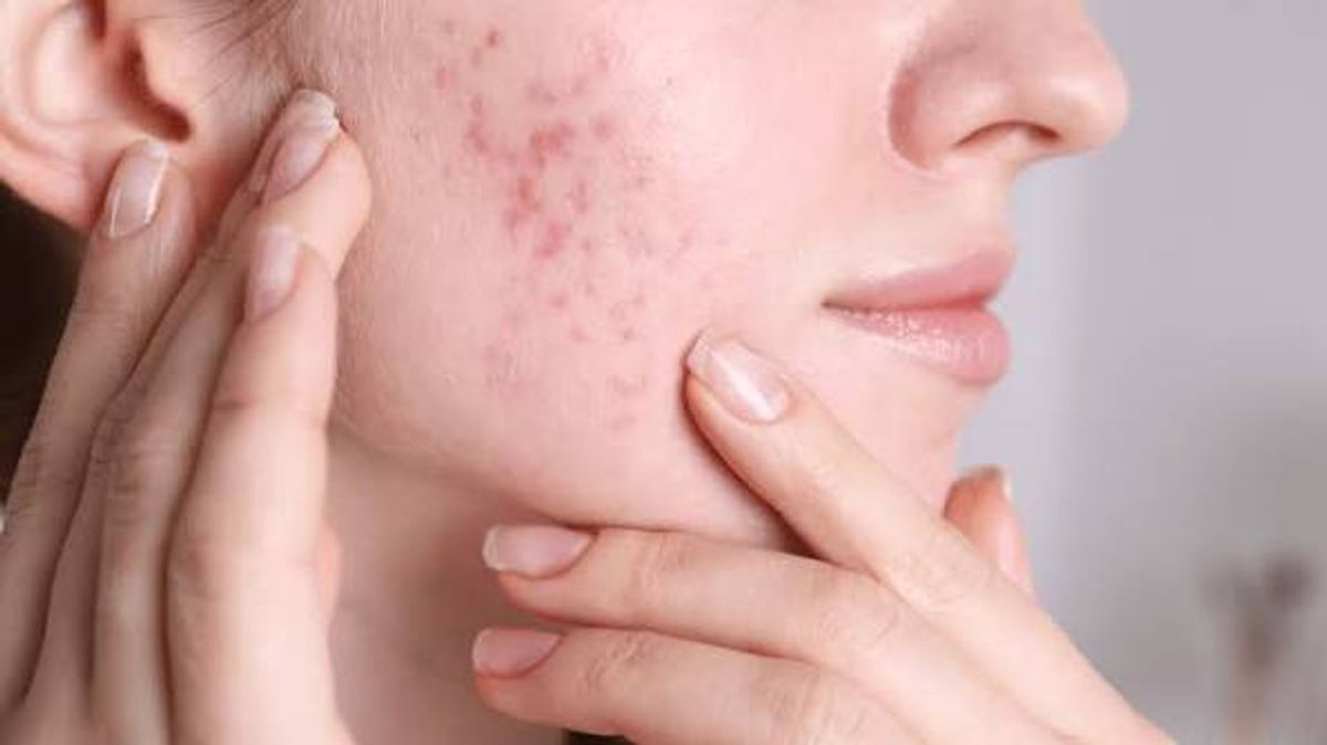 Mụn viêm kéo dài ở vùng da mặt 