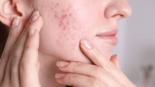 Mụn viêm kéo dài ở vùng da mặt
