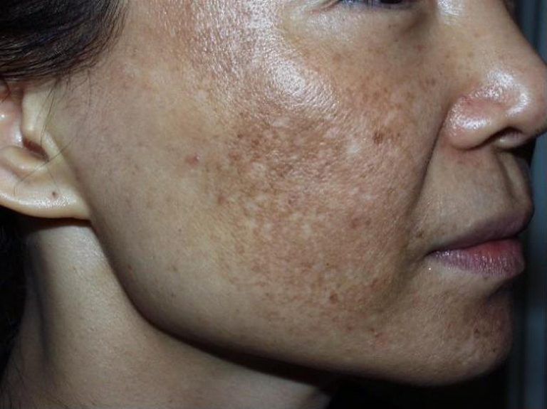 Nám da làm cho bạn mất tự tin hơn