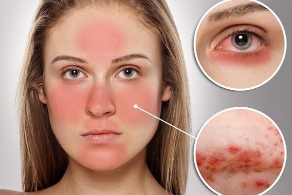 Ban đỏ hình cánh bướm, đặc trưng của bệnh Lupus ban đỏ hệ thống