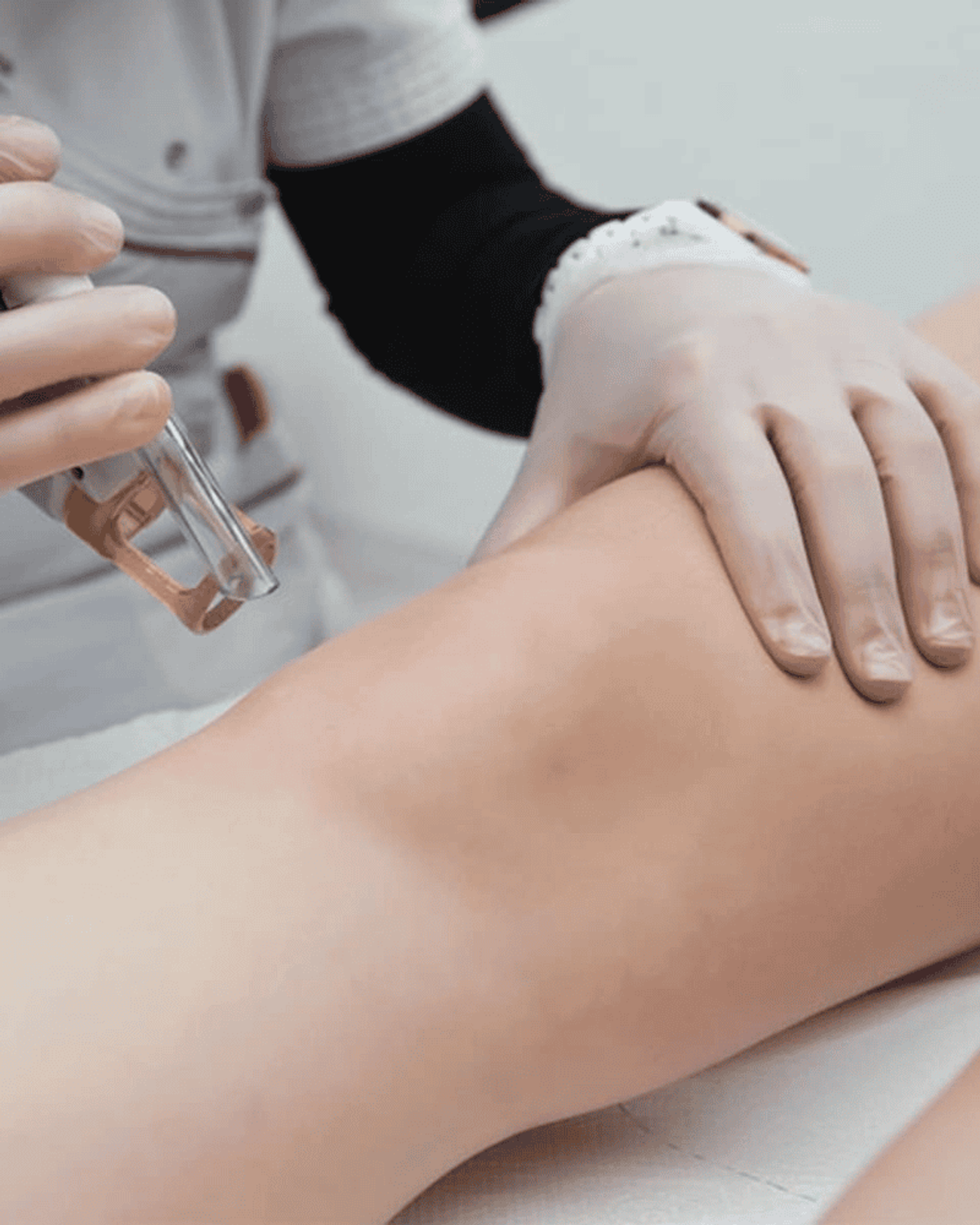 Điều trị thâm đầu gối bằng laser công nghệ cao