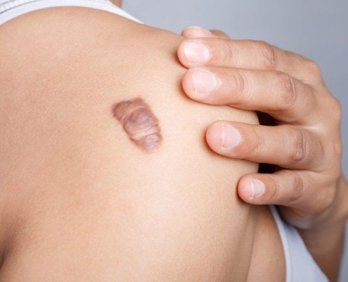 Sẹo lồi không được điều trị đúng 
