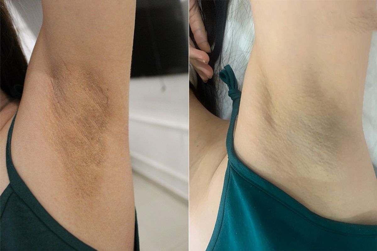 Điều trị thâm nách sau 3 buổi