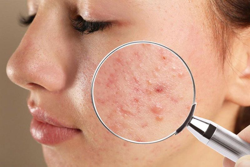 Tình trạng mụn viêm nặng