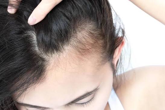 Rụng tóc ở các bạn gái tuổi dậy thì 