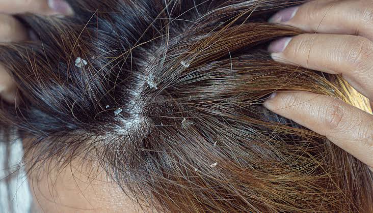 Rụng tóc do viêm da đầu các mảng gàu trắng