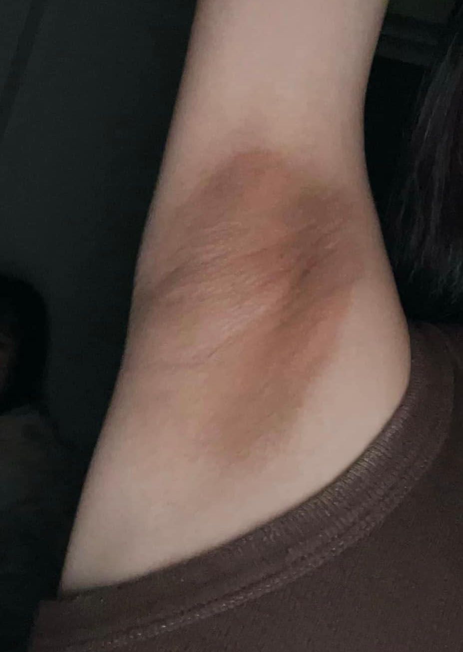 Thâm nách gây mất thiện cảm