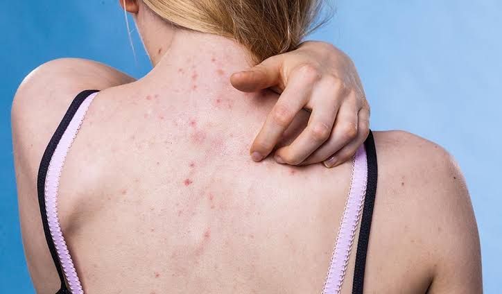 Điều trị mụn lưng giúp lấy lại sự tự tin