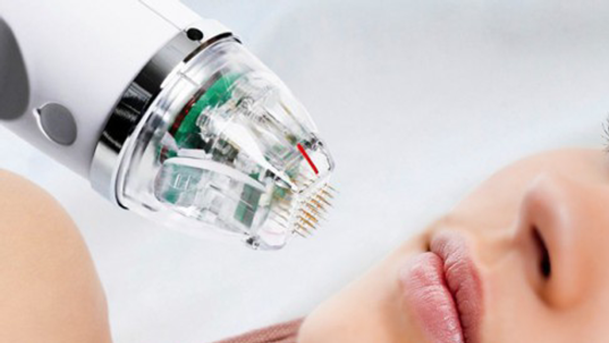 RF trị sẹo lõm