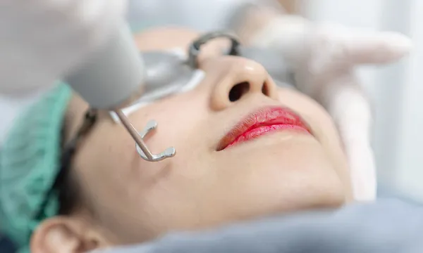 Điều trị nám da 