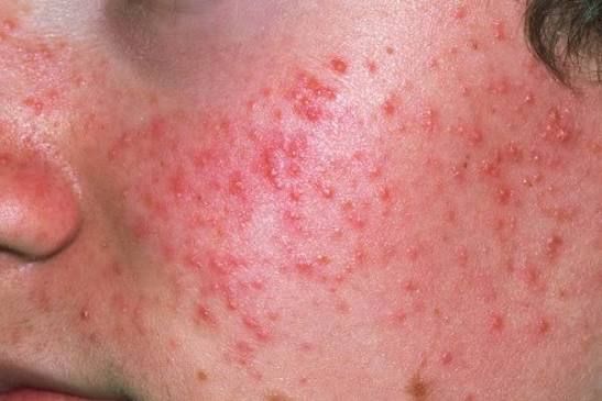 Mụn trứng cá xuất hiện theo cụm ở vùng má