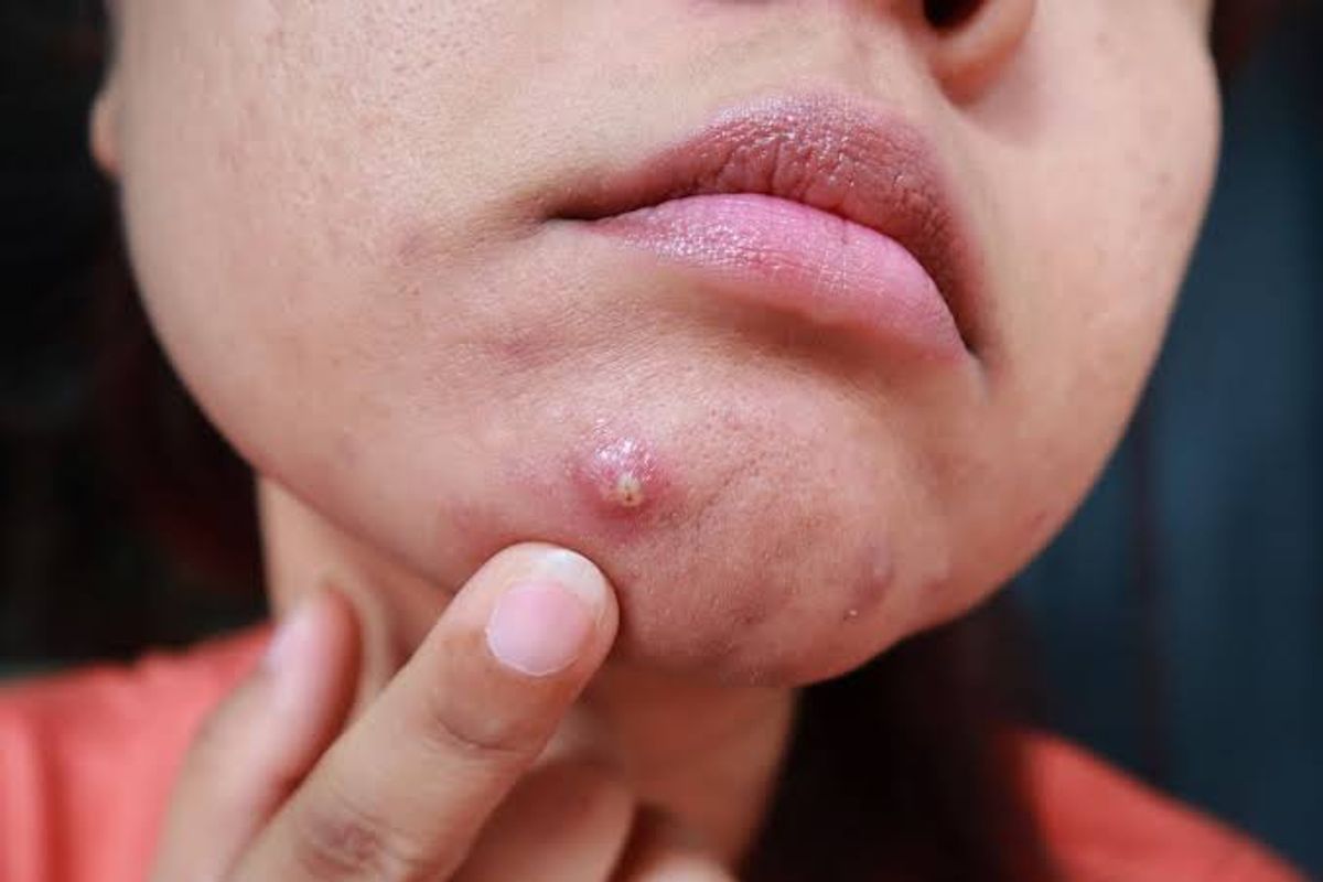 Điều trị mụn bọc an toàn không để lại sẹo 