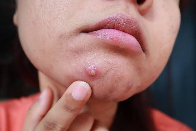 Điều trị mụn bọc an toàn không để lại sẹo