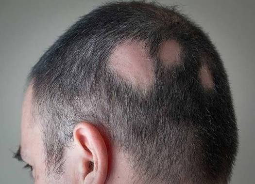 Rụng tóc tự miễn ở đàn ôn