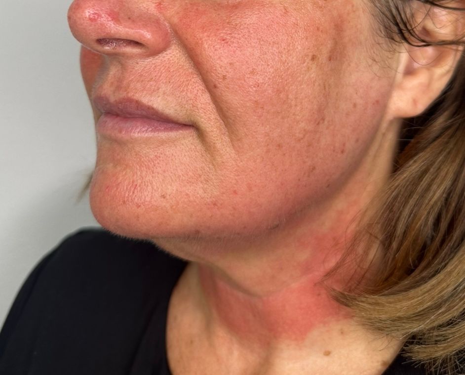 microneedling