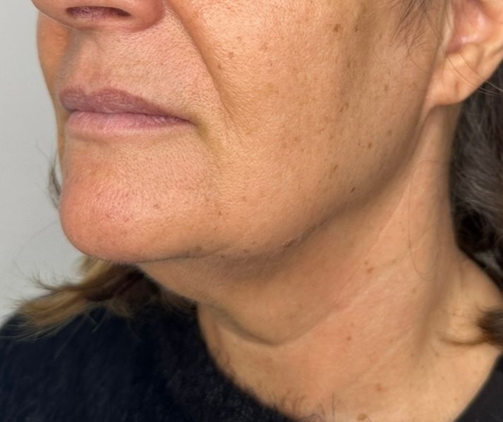 microneedleing