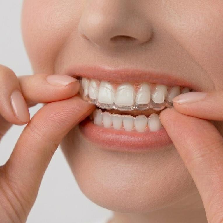 Aligners & Retainers