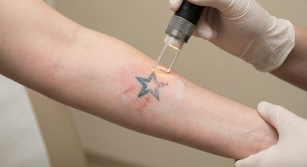 Pico laser for tattoo removal