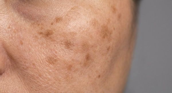 Pico laser for sun spots and freckles