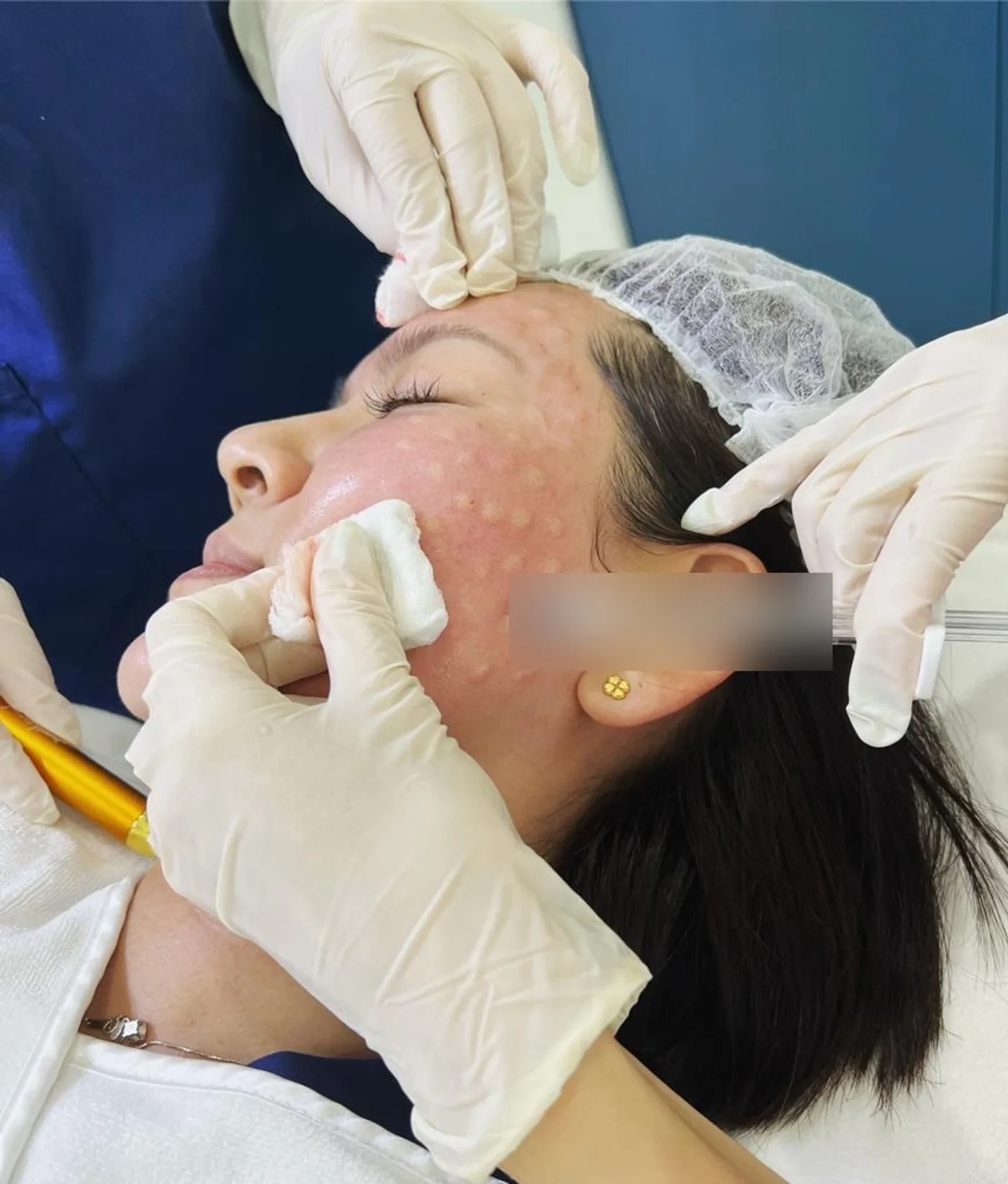 Dr Samantha injecting the Signature Glow Booster (Rejuran Healer + Teosyal Redensity 1) through a sterile drape at Nexus Aesthetic Singapore