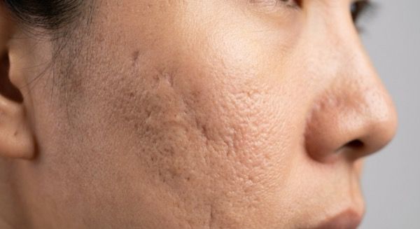 Pico laser for acne scars