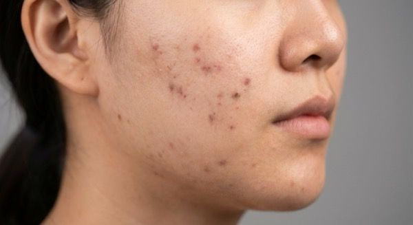 Pico laser for melasma