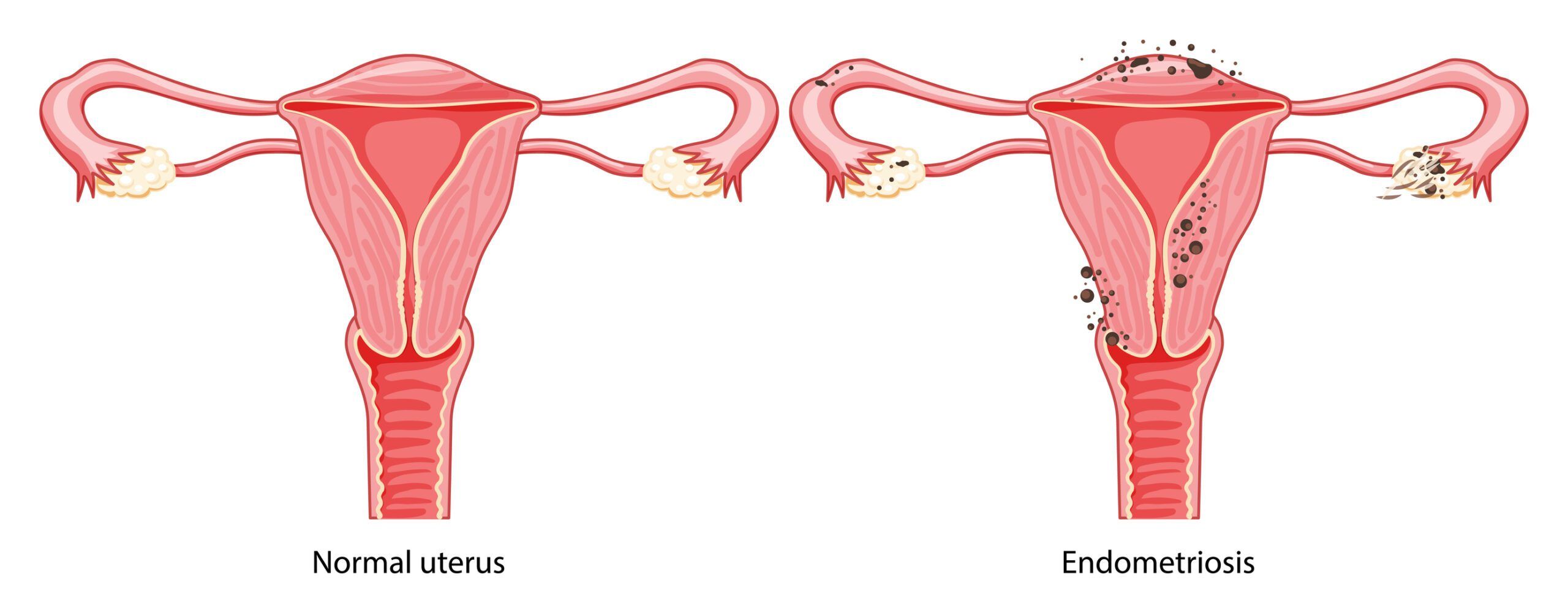 Endometriosis Diagram