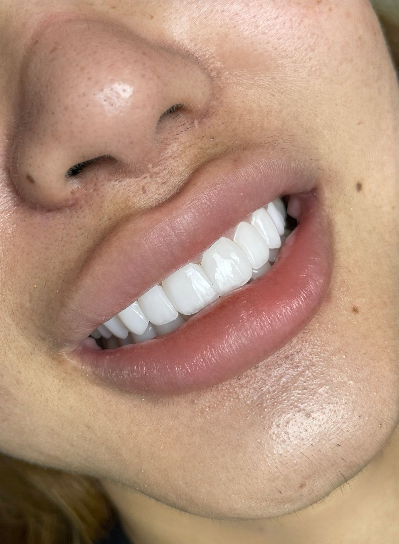 Blue Diamond Veneers
