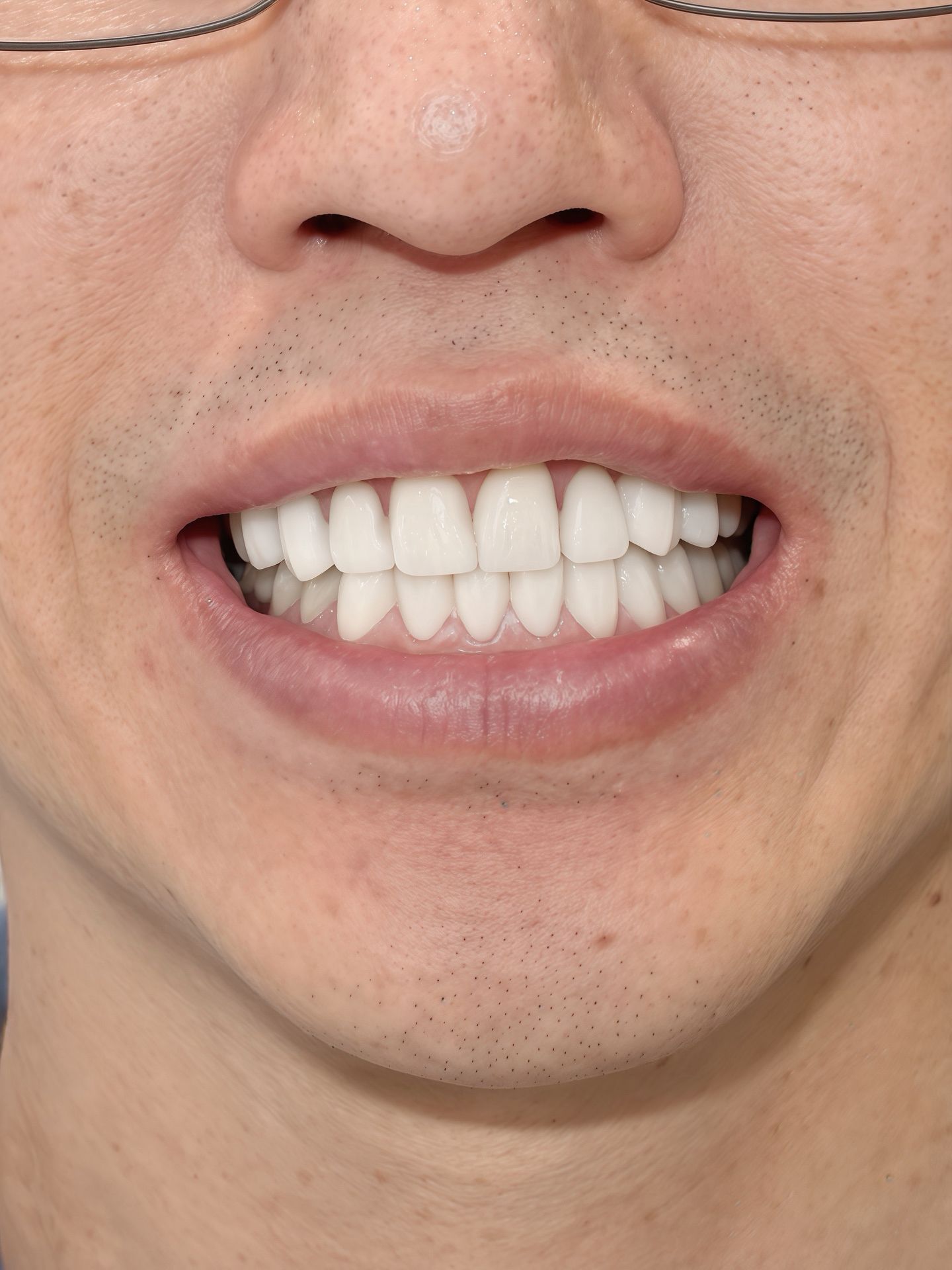 Zirconia Veneers