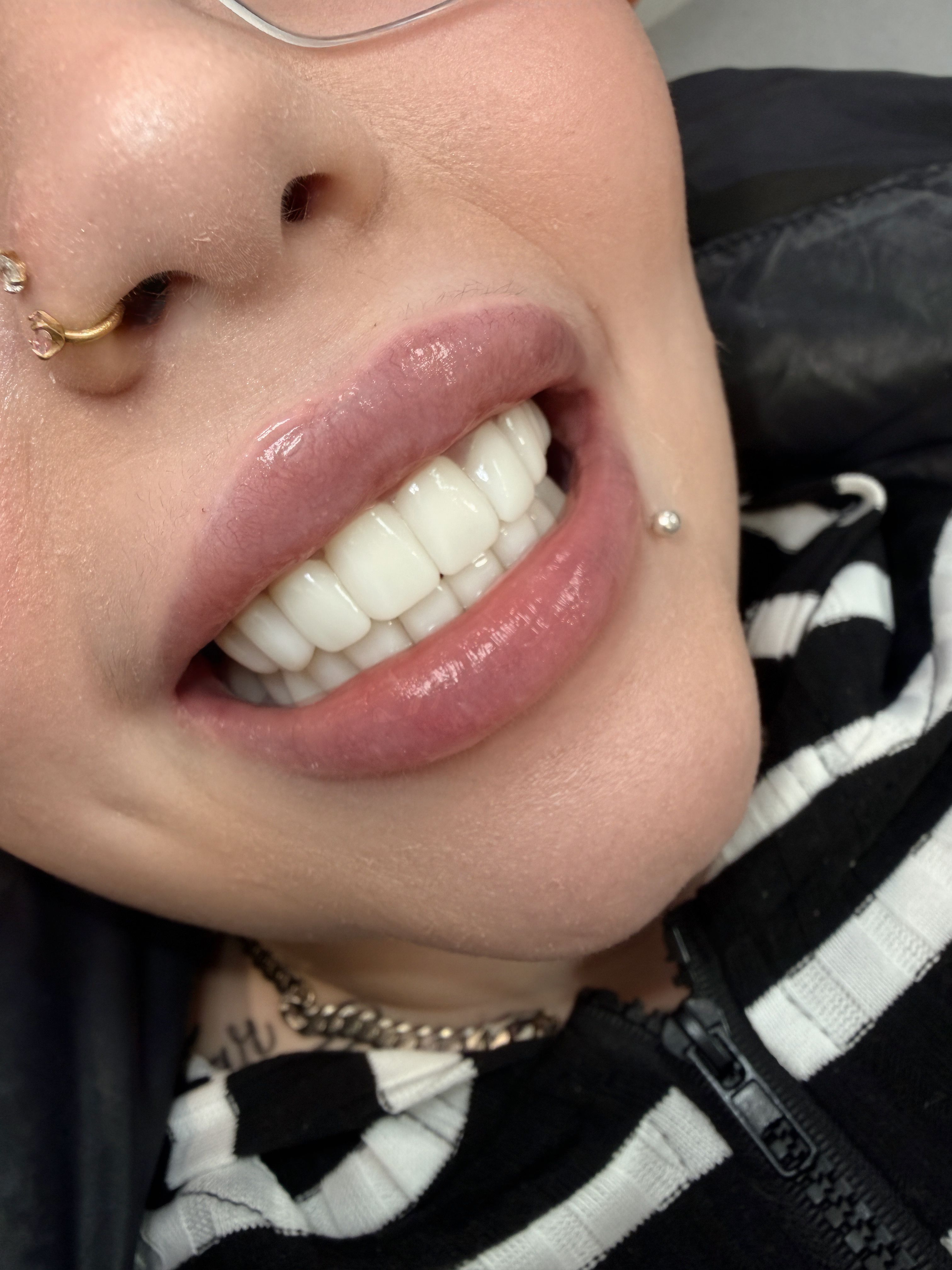E-Max Veneers