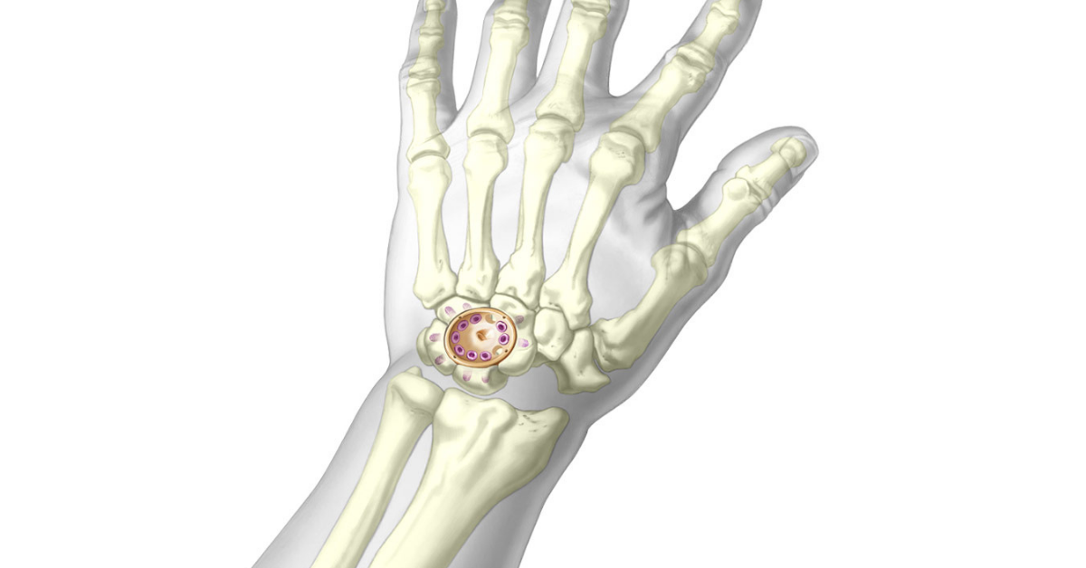 Third time's the charm for a Class III medical device manufacturer