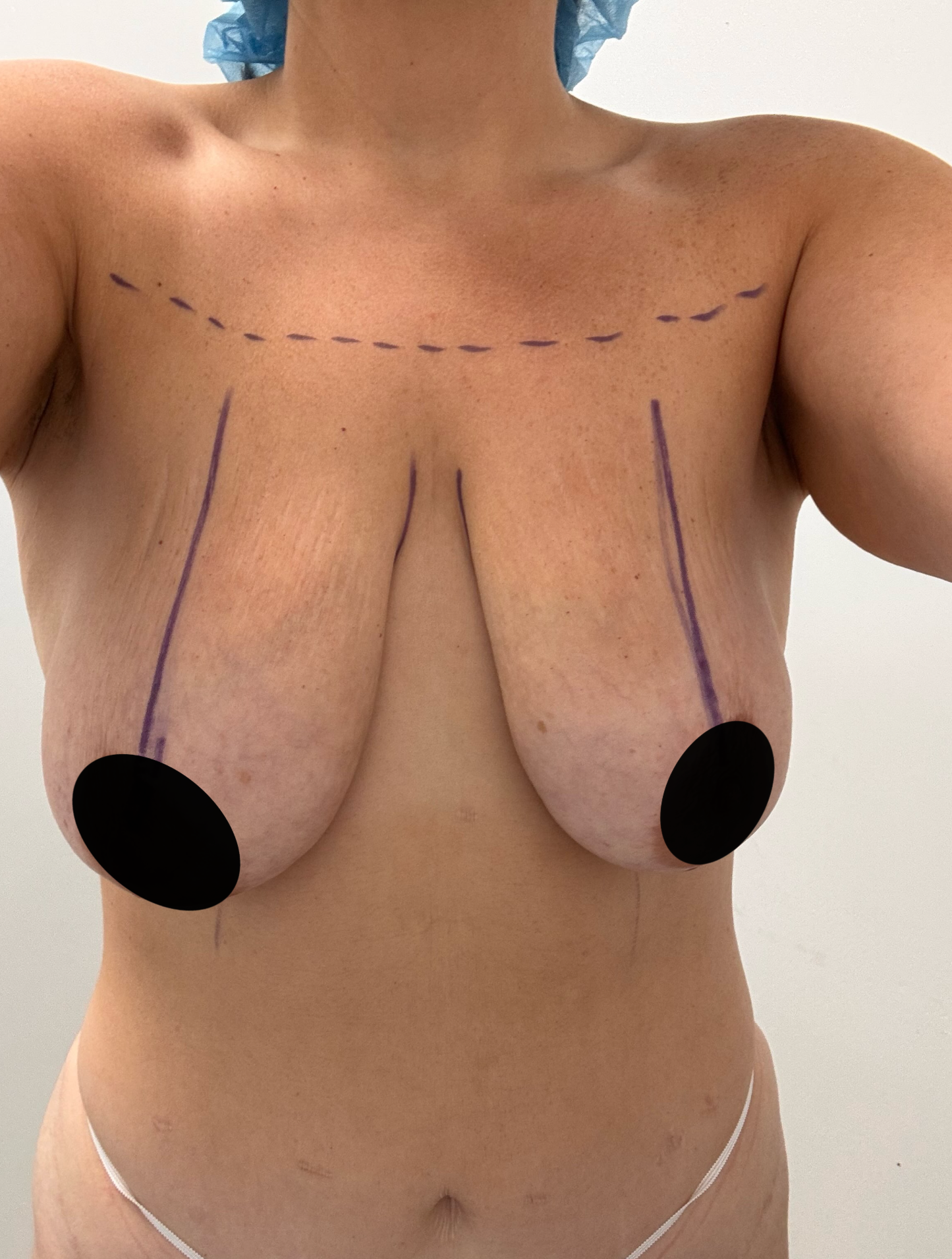 Before and after Breast Lift result 1