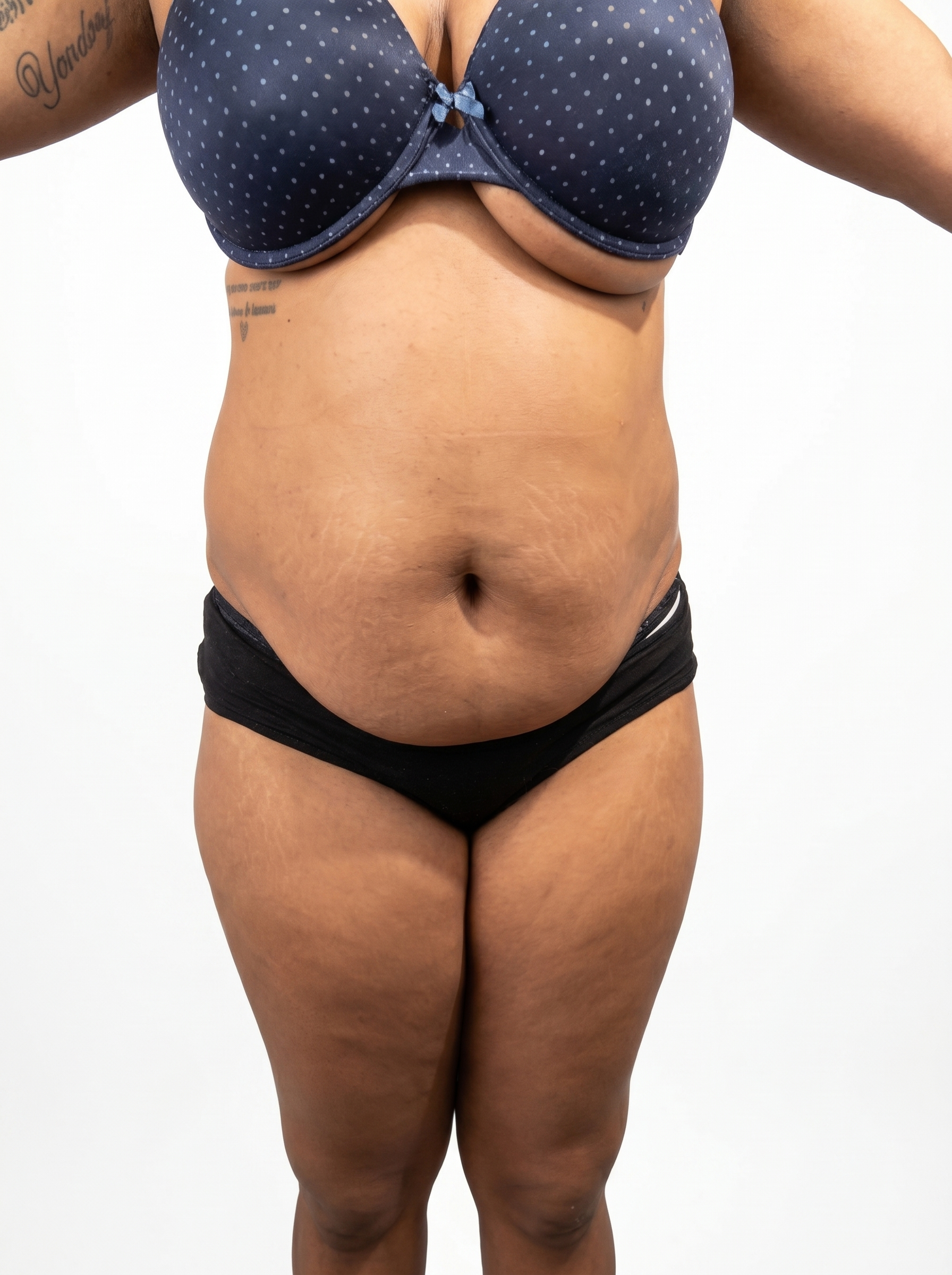 Before and after Tummy Tuck result 2