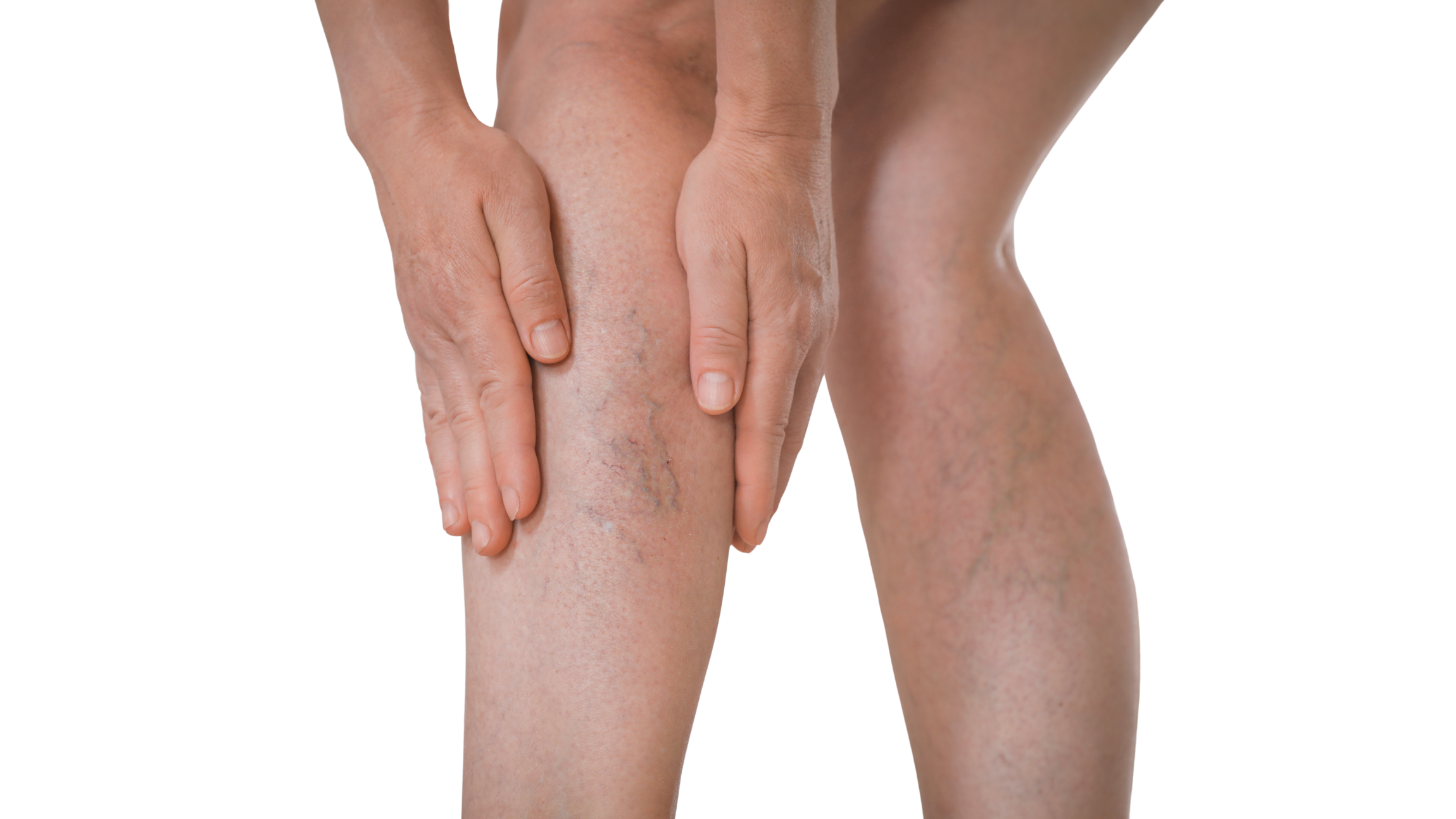 Hormones and Varicose veins