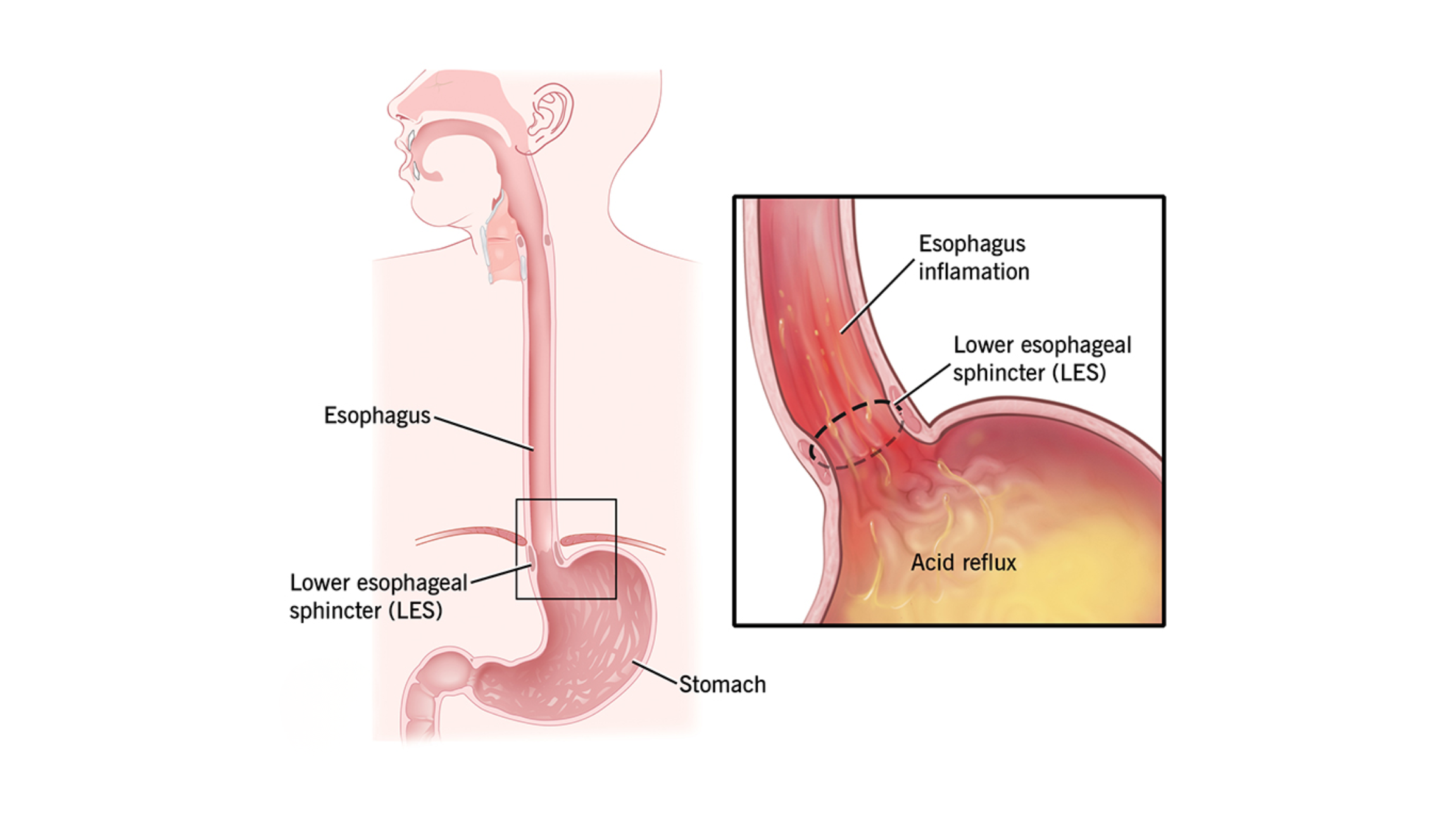 Acid Reflux