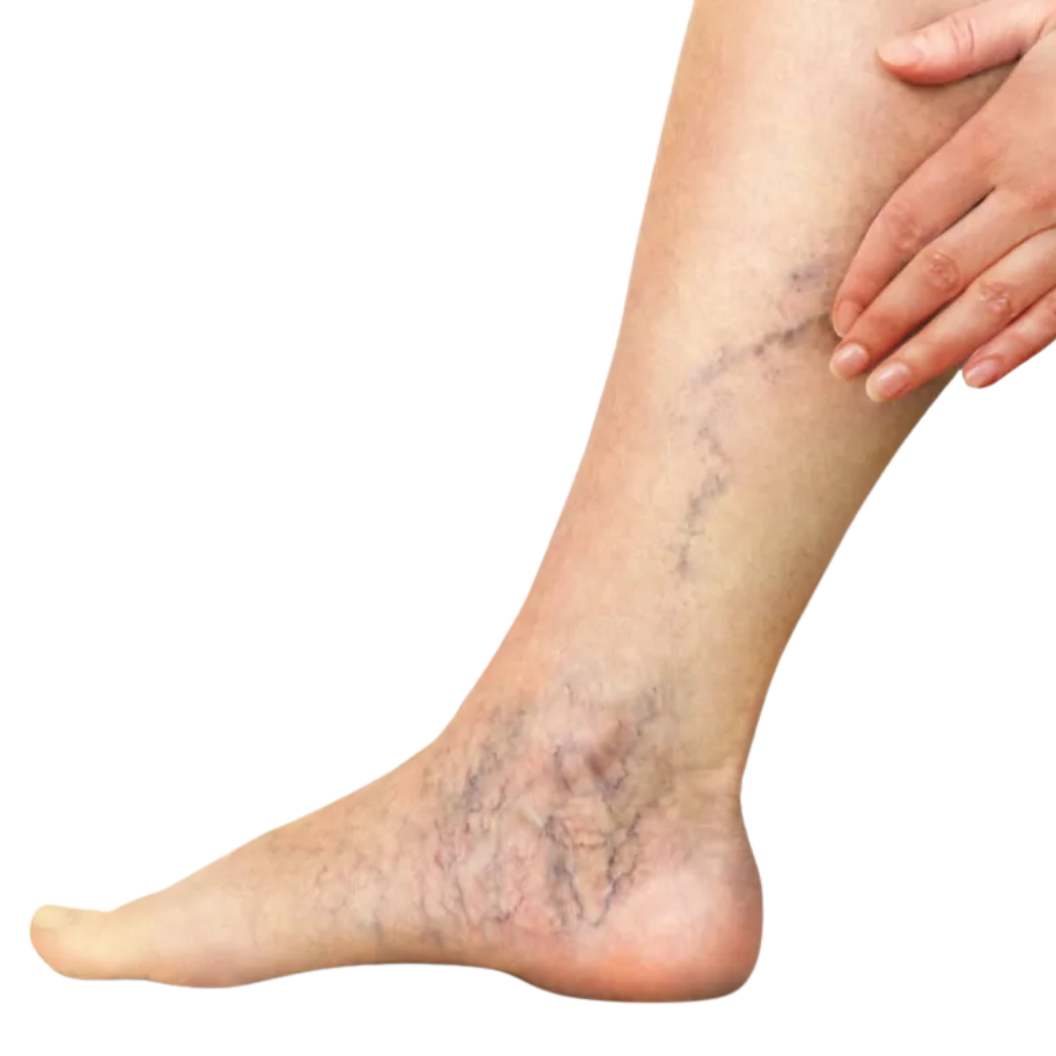 Varicose veins laser treatment (EVLA) on legs by Dr. Abhishek, vascular and general surgeon