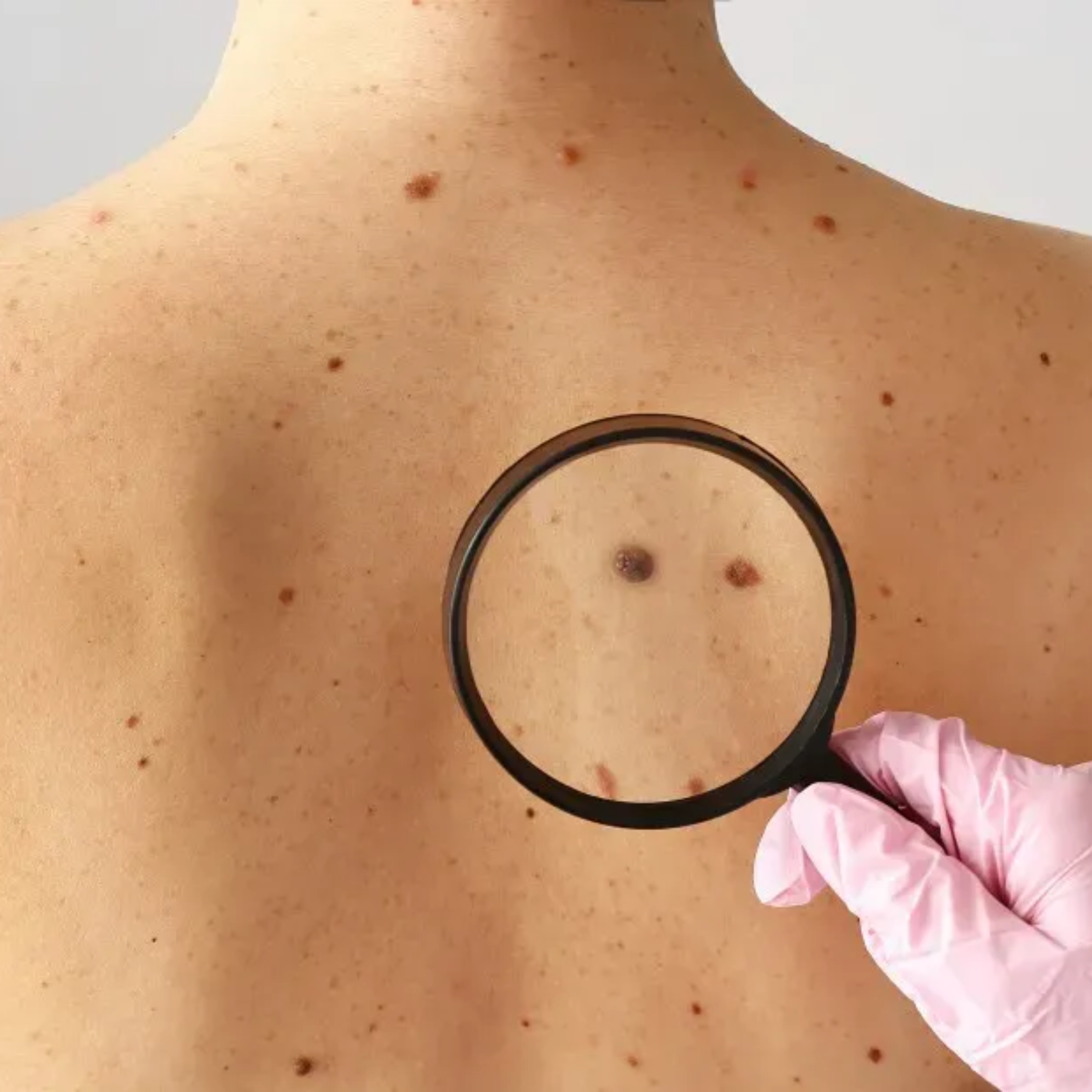 Skin tumor removal through day-care excision surgery by Dr. Abhishek, general surgeon