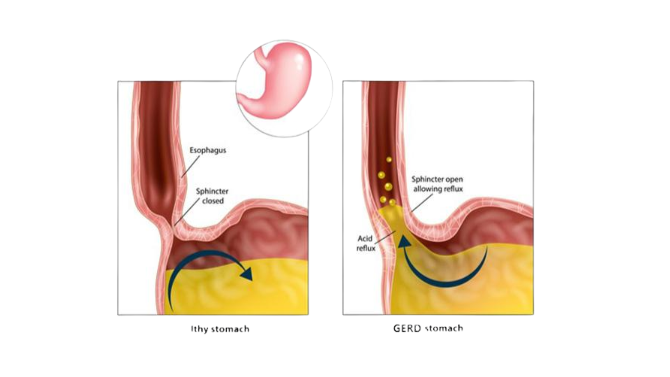 Untreated GERD