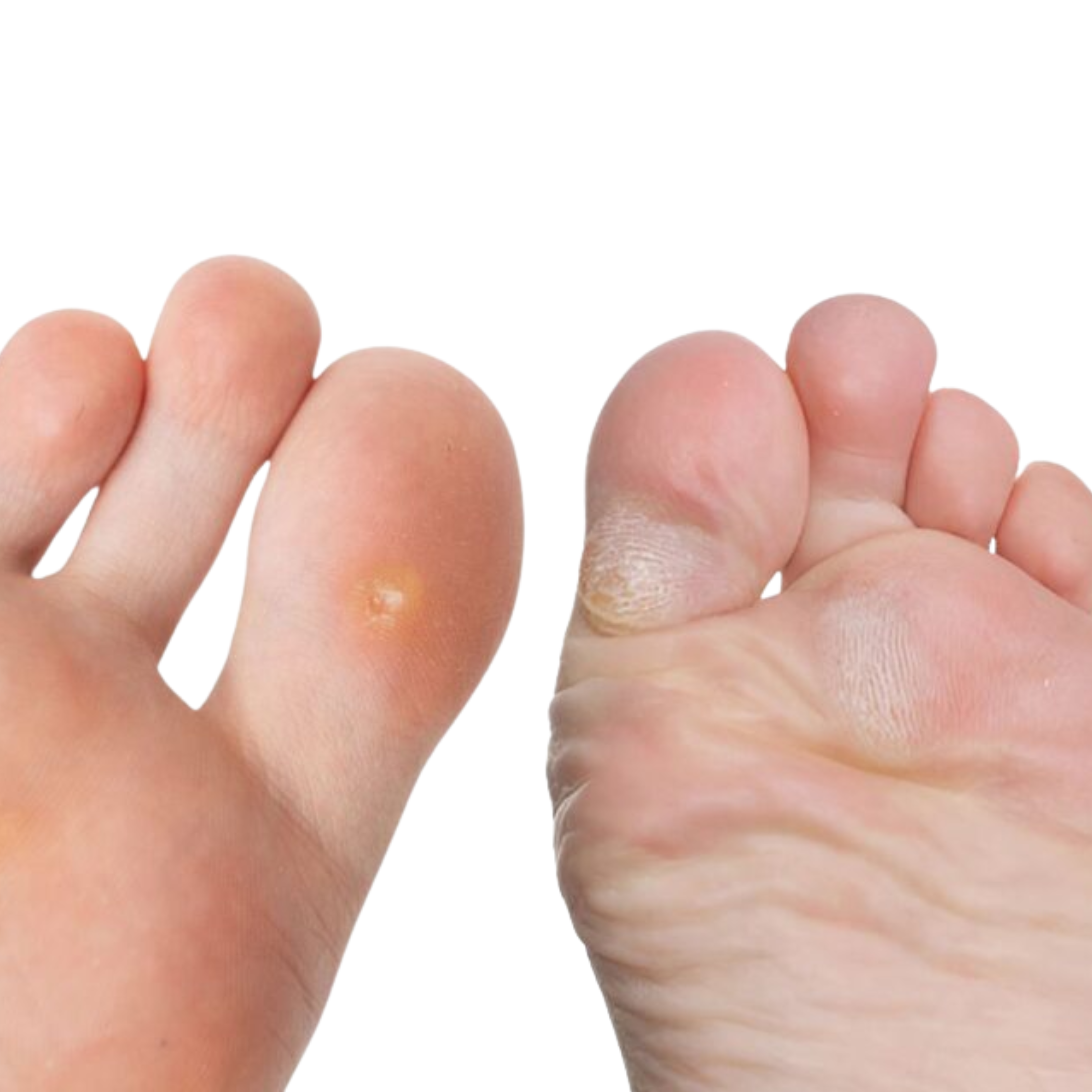 Foot corn removal surgery under local anaesthesia by Dr. Abhishek, general surgeon