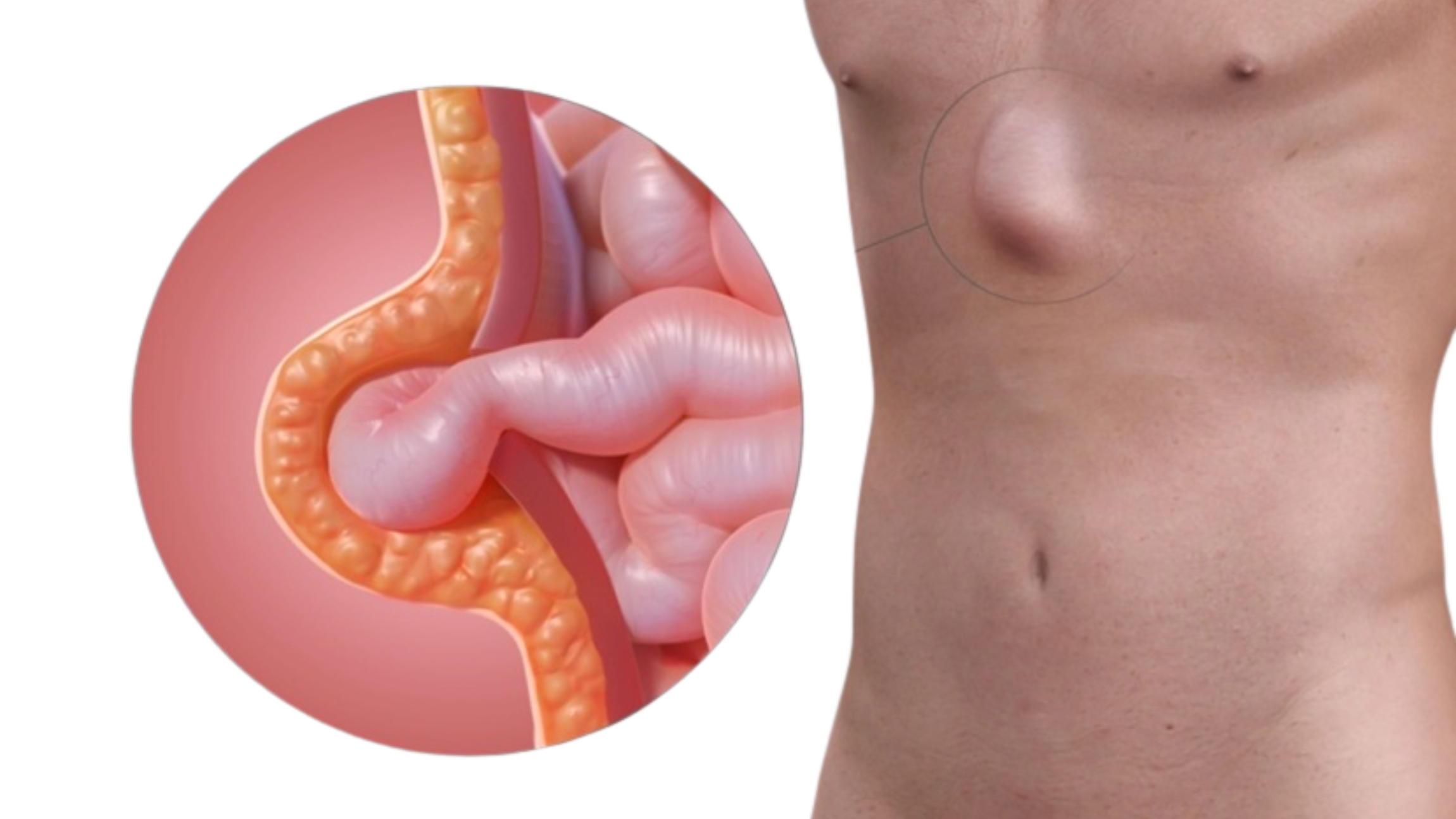 Early signs of hernia