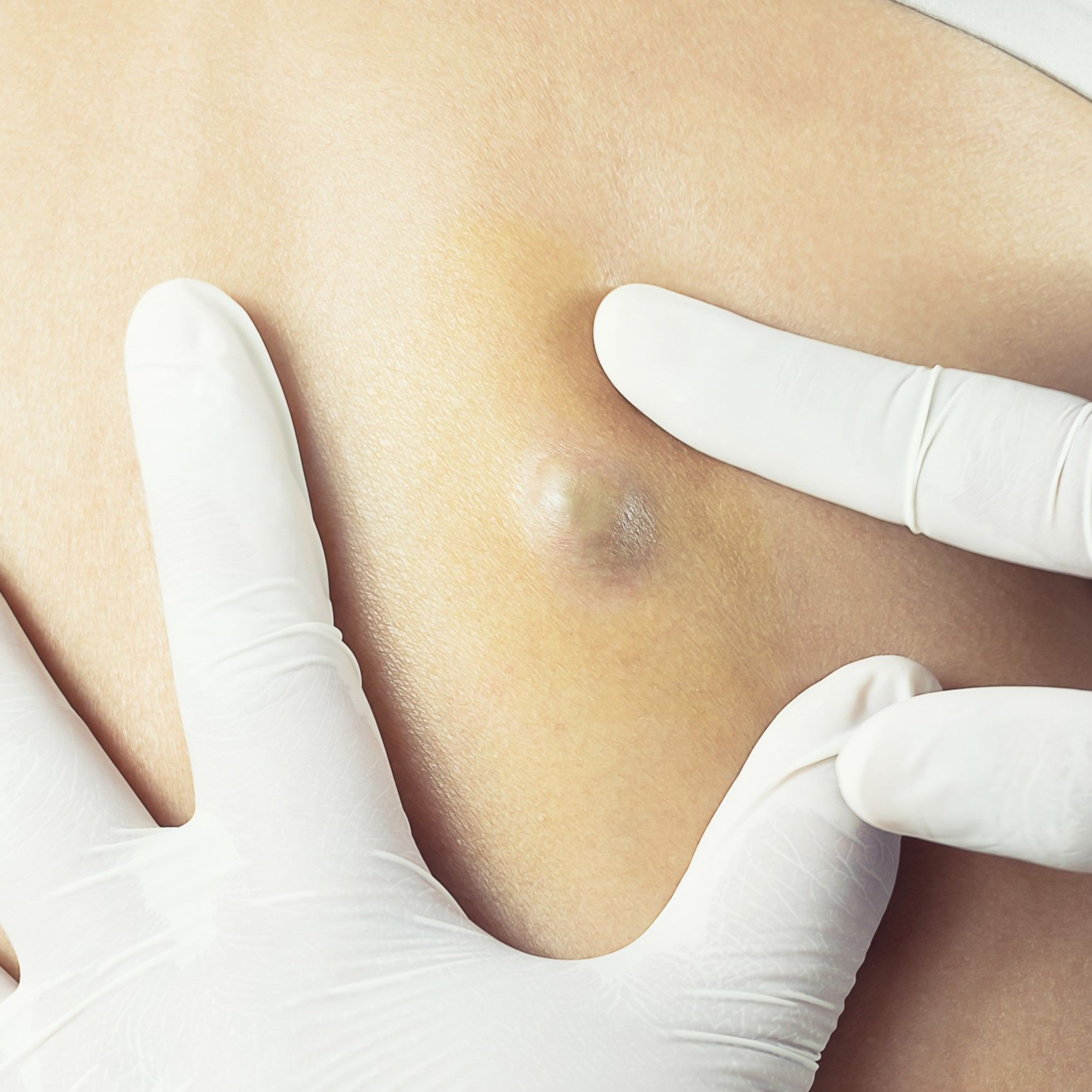 Sebaceous cyst removal surgery with complete excision by Dr. Abhishek, general surgeon