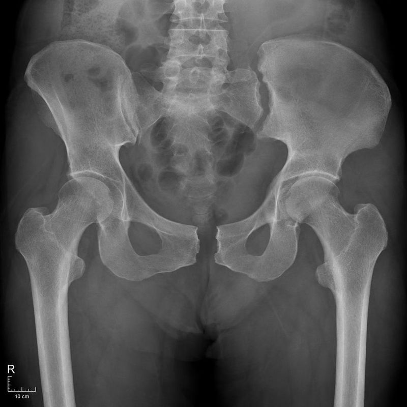 A portable AP pelvic X-ray obtained during trauma assessment.
