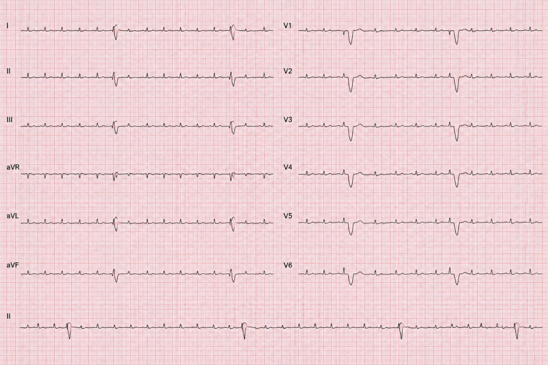 A standard 12-lead ECG with a lead II rhythm strip.