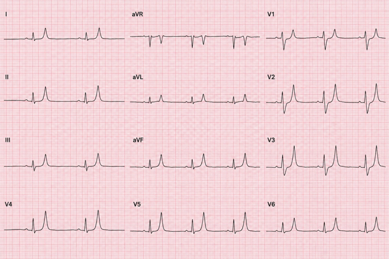 A standard 12-lead ECG recorded in a patient with weakness and renal impairment.