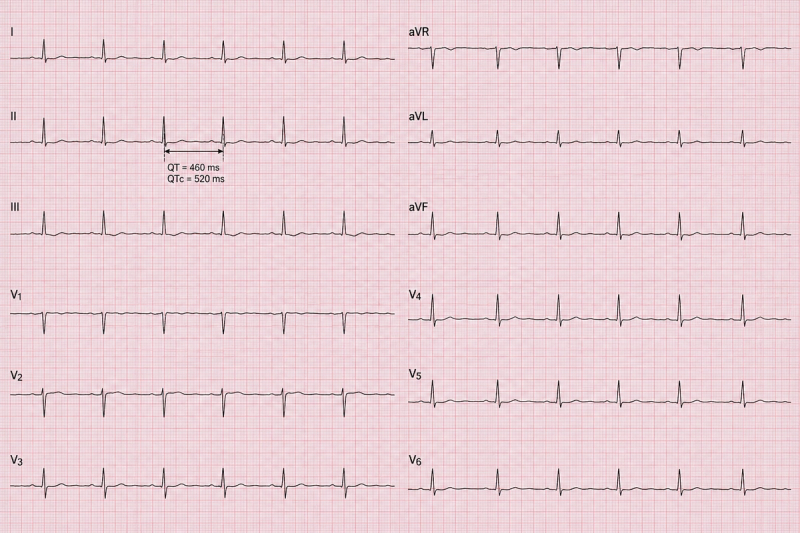 A standard 12-lead electrocardiogram.